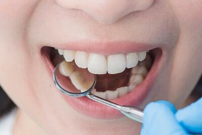 با مصرف این دارو مجدد دندان های شما رشد می کند