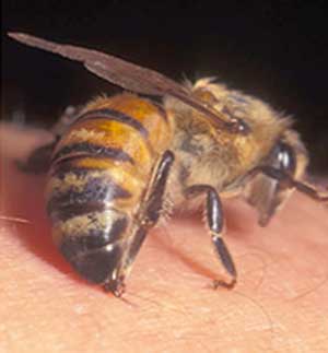 زنبور گزیدگی