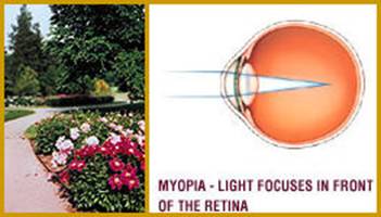 نزدیک بینی Myopia