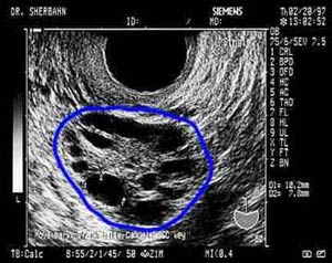 خطر سونوگرافی برای جنین