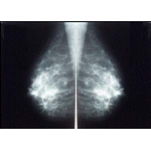 تشخیص سریع سرطان پستان