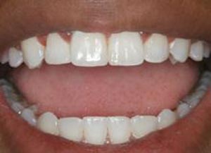 آشنایی با عوامل موثر در پوسیدگی دندان