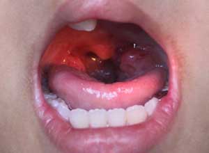 باکتری های عامل ابتلا به سرطان دهان
