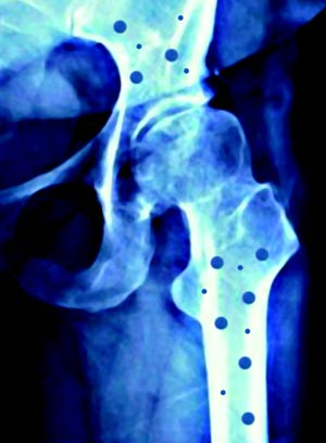پوکی‌ استخوان( osteoporosis‌)