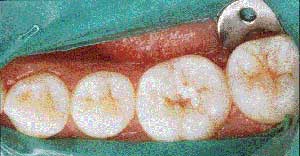 مسدود کننده‏ها: بیمه طویل المدت دندان
