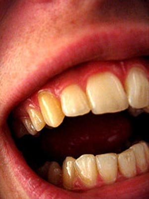 چرا رنگ دندانهای بعضی افراد زرد است؟