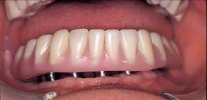 آسیبهای ناشی از دندان مصنوعی