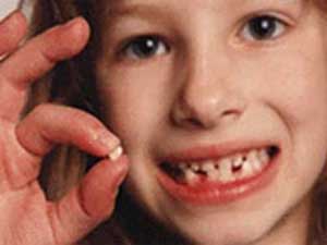 چگونه از زود افتادن دندانهای شیری و رویش نادرست دندانهای دائمی جلوگیری کنیم ؟