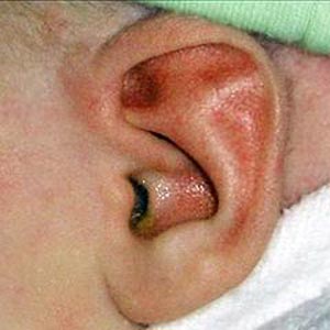 عفونت گوش در کودکان
