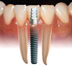 بارگذاری فوری در ایمپلنت‌های دندانی