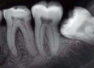تراشیدن دندان توسط دندانپزشکان عصر حجر در ۹۰۰۰ سال پیش