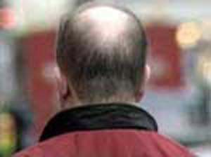 ارتباط ریزش موی سر در آقایان با حملات قلبی