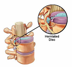 درمان غیر جراحی دیسک بین مهره ای