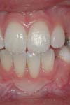 بررسی تغییرات قوسهای دندانی بیماران متعاقب استفاده از دستگاه اکسپنشن Y شکل