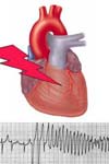 رابطه سطح سرمی و تجویز منیزیم با آریتمی های پس از عمل در جراحی عروق قلب