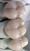 بررسی استحکام باند چینی دندانی اپک T۱۱۴ و دنتین D۴ جدید مورد استفاده در سیستم چینی- فلز و مقایسه آن با چینی دندانی کارخانه ویتا