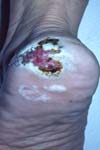گزارش یک مورد آکرال لنتیجینوس ملانوما؛ که به مدت ۱۶ ماه با تشخیص زخم مزمن درمان می شد