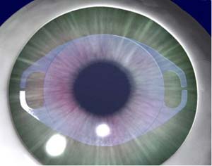 لنز هایی که در طول شب نزدیک بینی را اصلاح می کنند