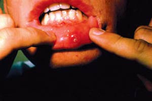 زخم های دهانی، علت ها و درمان ها