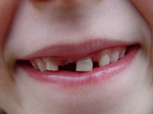 اهمیت دندان های شیری وحفظ آن