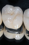 مقایسه استحکام خمشی پرسلن دندانی جدید (D۴ Dentin) با پرسلن دندانی کارخانه VMK ۶۸N) Vita)