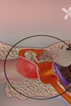 نتایج جراحی تمپانوماسویید در عفونت مزمن گوش میانی در دو زمینه خشک و مرطوب