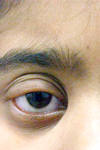 تغییرات چشمی در آلوپسی آره آتا