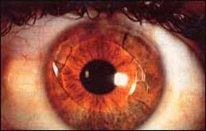 لنز داخل چشمی (IOL)
