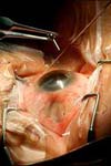 نتایج و عوارض عمل جراحی داکریوسیستورینوستومی بیرونی در مراکز چشم پزشکی یزد