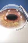 گزارش نتایج و عوارض عمل فیکو و کارگذاری لنز داخل چشمی