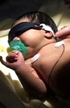 بررسی بیماری همولیتیک نوزادان به علت ناسازگاری ABO