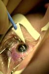 نقص بالا بردن یک چشم: گزارشی از بیماران جراحی شده طی ۱۰ سال در بیمارستان لبافی نژاد