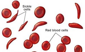 کم خونی سلولهای داسی شکل