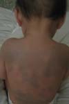 شیوع خال های ملانوسیتیک و اختلالات پیگمانتاسیون و همراهی بین آنها در کودکان زیر ۷ سال در چند مهد کودک تهران