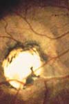 اثرات تجویز کوتاه مدت و بلندمدت استرویید سیستمیک در درمان توکسوپلاسموز چشمی