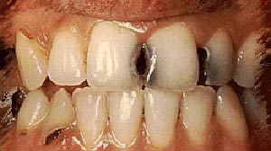 پوسیدگی دندان چرا و چگونه ایجاد می شود؟