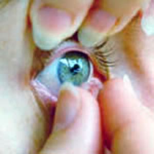 برخوردهای بیولوژیک لنزهای تماسی چشمی