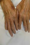 تظاهرهای پوستی در بیماران مبتلا به آرتریت روماتویید