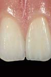 تحلیل تنش دندان‌های قدامی ماگزیلا به هنگام اعمال نیروی اینتروزیو بین لترال و کانین