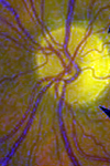 نوروتومی عصب بینایی از طریق ویترکتومی برای درمان نوروپاتی ایسکمیک قدامی غیرآرتریتی عصب بینایی