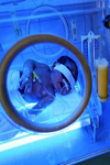 ارزیابی تاثیر اتاق آینه در کاهش هیپربیلی‌روبینمی نوزادی