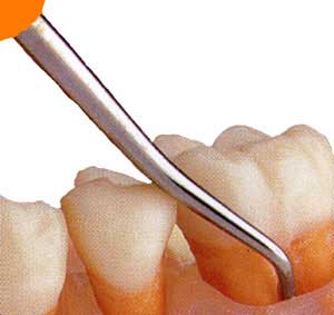 بیماریهای بافتهای نگهدارنده اطراف دندان