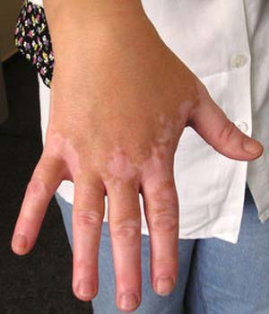 از ویتیلیگو یکی از شایع ترین بیماری های پوستی چه می دانید؟