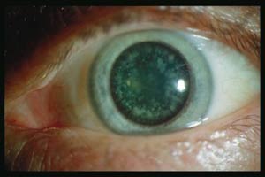 جراحی لیزری چشم