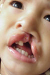 بررسی ناهنجاری قلبی در کودکان مبتلا به شکاف‌های دهانی در بیمارستان‌های دانشگاه‌های علوم پزشکی تهران