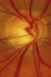 اثر ایریدوتومی با لیزر در قسمت تحتانی در مقایسه با قسمت فوقانی عنبیه در درمان کلوکم زاویه بسته