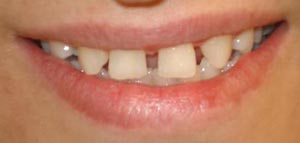 دندان های فاصله دار و روش های درمان آن