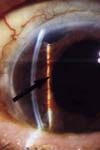 گلوکوم زاویه باز، گلوکوم مشکوک و هیپبتانسیون چشمی در اربیتوپاتی گریوز