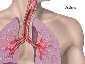 چگونگی برخورد با بیماری آسم