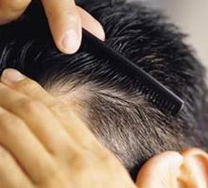 درمان ریزش مو توسط مینوکسیدیل